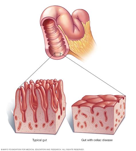 Celiac disease - Symptoms and causes - Mayo Clinic