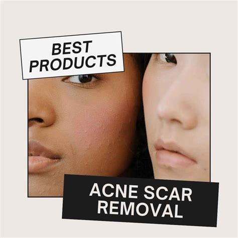 Best Products For Acne Scars UK 2023 | Products For Spotless Skin I ...