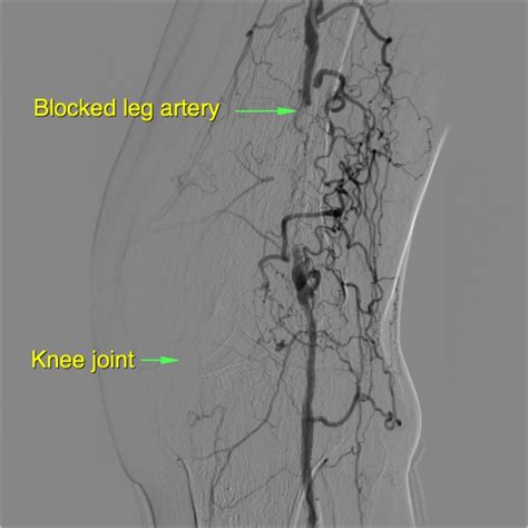 Angioplasty and Stent Insertion of Leg Arteries – Sydney Medical Interventions