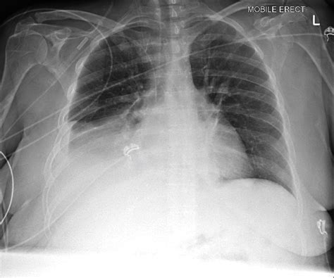 Chest X Ray Consolidation