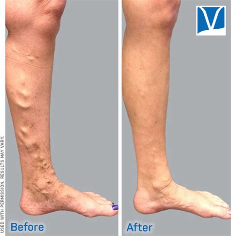 How Much Does Varicose Vein Treatment Cost Without Insurance?