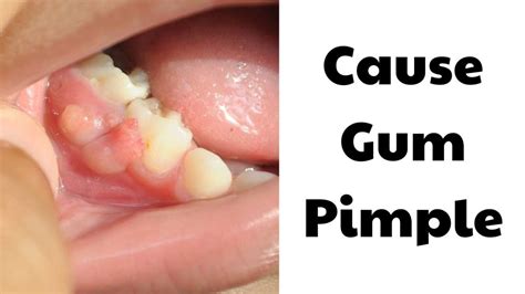 Gum Pimple: Causes & Treatment At Spring Orchid Dental