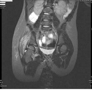 MRI scan of the pelvis of Patient C demonstrating an abscess in the... | Download Scientific Diagram