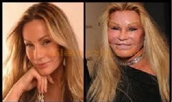 Jocelyn Wildenstein Plastic Surgery Failure Gives Odd Looks – Before ...