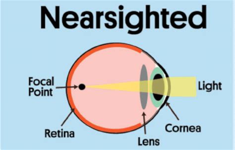 Nearsightedness Causes: What to Know in 2024 - International Clinics