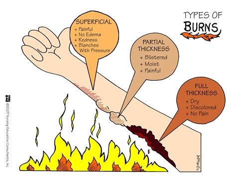 Types Of Burn Patterns