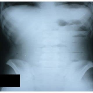 X-ray of the abdomen showing diffuse fecal loading. | Download Scientific Diagram