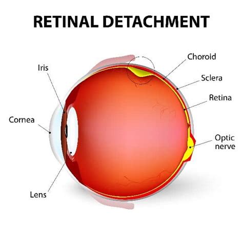 Retinal Tear Treatment Reading, PA - Retinal Detachment Info