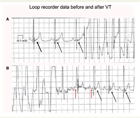 Figure 4 from Epsilon wave on an electronic loop in a case of ...