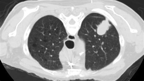 NHS to roll out mobile lung cancer scanning across England - Cancer ...