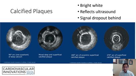 IVUS guided PCI: step-by-step_Seto_Coronary On Demand - YouTube