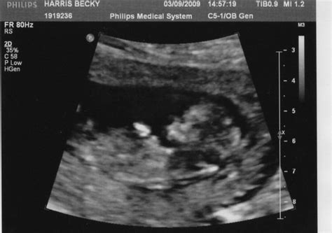 12 week baby scan no2 by tigertaiga on DeviantArt