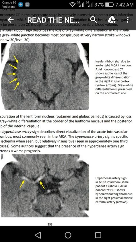 #acute stroke. Types Of Strokes, Mri, One Month, Neurology, Radiology ...