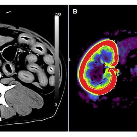 | Renal blood flow analysis using computed tomography perfusion images.... | Download Scientific ...