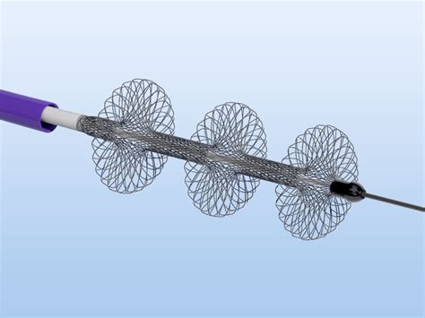 Inari device blasts through pulmonary embolism study endpoints | 2020 ...