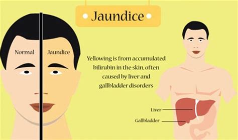 Jaundice - Dr. Pathik Parikh