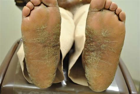 Psoriasis | The Foot and Ankle Online Journal