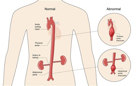 Marfan Syndrome Aortic Aneurysm And Dissection Thoracic Key | The Best Porn Website