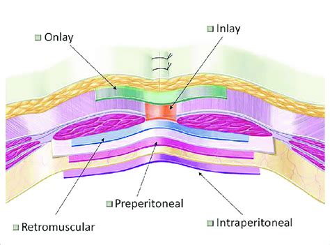 Types of the incisional hernia repair according to mesh fixation areas. | Download Scientific ...