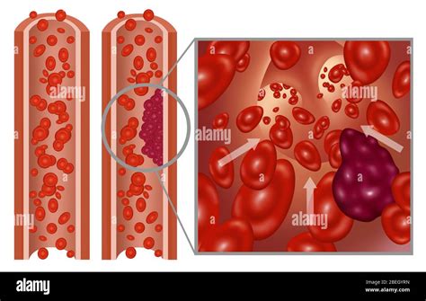 Arterial Thrombus and Embolus Stock Photo - Alamy