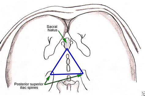 Anesthesia, Caudal; Anesthesia, Sacral Epidural