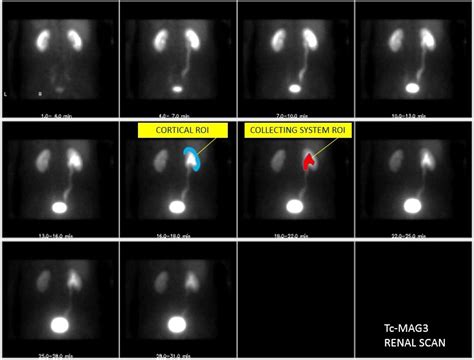 Renal Scan MAG3 example abeled | Nuclear medicine, Medical knowledge ...