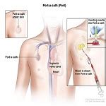 Dressing Change & Flush Port-a-Cath Instructions – MedView Systems