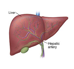 Chemoembolization for Liver Cancer: The Procedure | Saint Luke's Health System