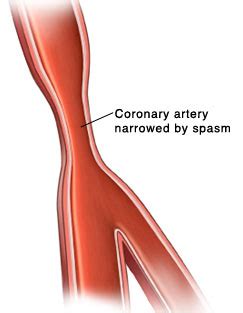 Coronary Artery Spasm | Saint Luke's Health System