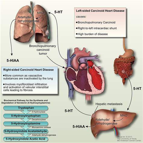 Would a bronchial carcinoid tumor produce right or left sided heart disease with carcinoid ...