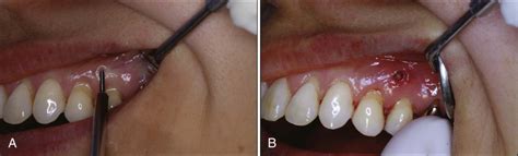 The Use of Microimplants in Orthodontics | Pocket Dentistry