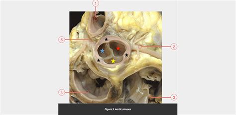 Aortic sinuses