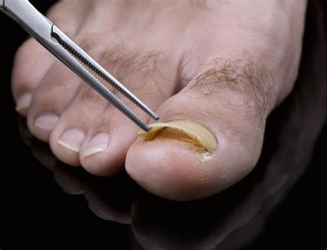 Subungual Melanoma vs Nail Fungus - Toenail fungus Treatment Center