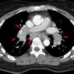 Sarcoidosis — Symptoms, Diagnosis and Treatment | Medical Library