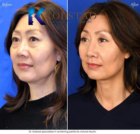 asian eyelid surgery san diego 502 copy | Dr. Kolstad - San Diego ...