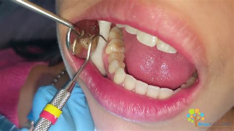 Molar Cavity Filling with Composite - Dental Clinic