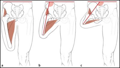 Principles of Amputation - Physiopedia