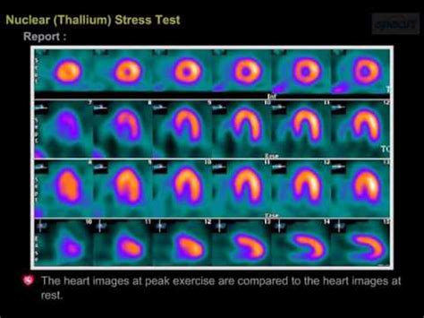 slsi.lk - how long for sulfatrim to work | Remarkable, can a nuclear stress test show a blockage ...