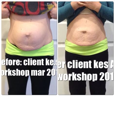 All New Before and After Pictures – Healing the Diastasis Recti 2015 ...