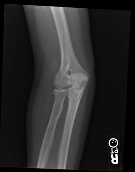 Radial head fracture - wikidoc