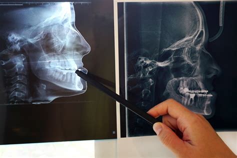 Symptoms and Causes of a Misaligned Jaw – Woodlawn Ortho