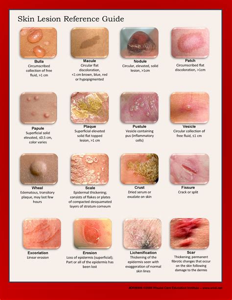 Cometti-Livingston rash skin - Skin Lesion Reference Guide Bulla Circumscribed collection of ...