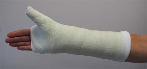 Scaphoid Fracture of the Wrist - OrthoInfo - AAOS