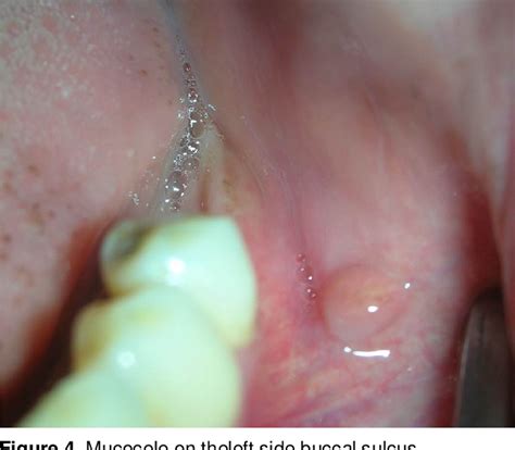 Oral Mucocele - Diagnosis and Management | Semantic Scholar