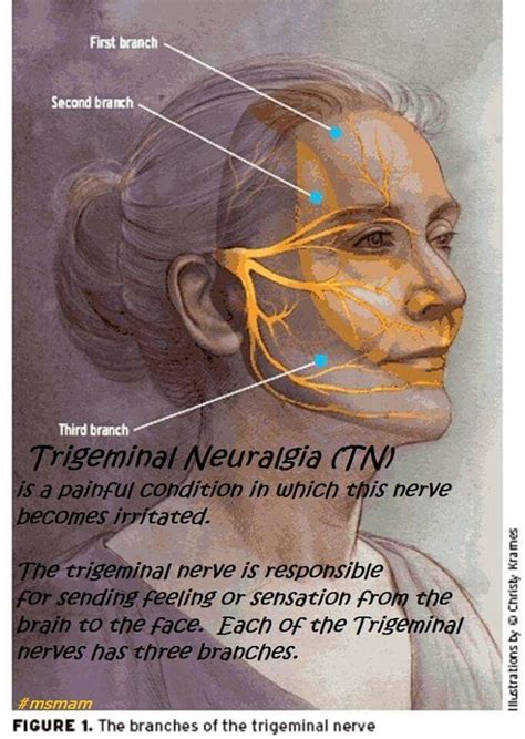 Trigeminal Neuralgia Trigeminal Neuralgia Nerve Pain - vrogue.co