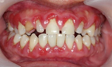 Periodontal Disease