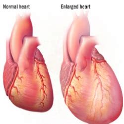 Enlarged Heart Causes, Symptoms, And Treatment – Natural Home Remedies & Supplements