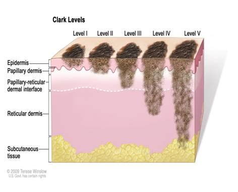 Melanoma - Albanesi.it