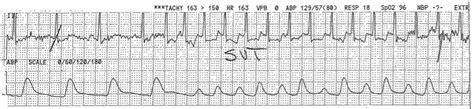 Svt Ecg Strip