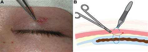 Treatment of Suture-related Complications of Buried-suture D ...